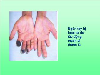 Bài giảng môn Ngữ Văn Lớp 8 - Tiết 45: Văn bản: Ôn dịch thuốc lá